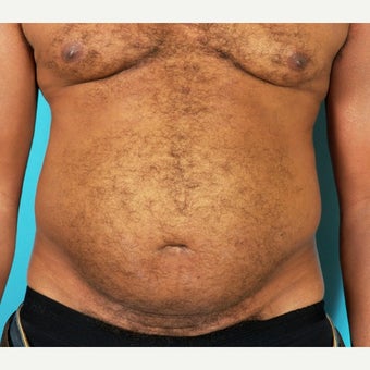 45-54 year old man treated with Painless/Drainless Tummy Tuck 8 Months Post-Op before 2235650
