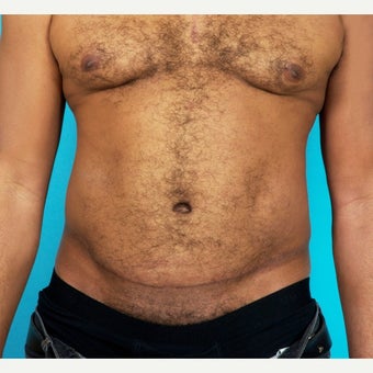 45-54 year old man treated with Painless/Drainless Tummy Tuck 8 Months Post-Op after 2235650