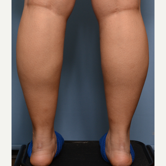 25-34 year old woman treated with Liposuction before 3234456