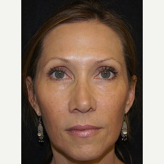 45-54 year old woman treated with Liquid Facelift after 1709617