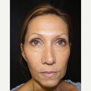 45-54 year old woman treated with Liquid Facelift before 1709617