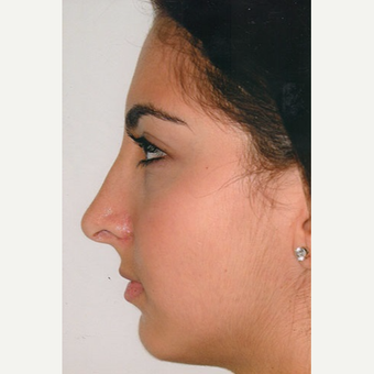 17 or under year old woman treated with Rhinoplasty after 3406276
