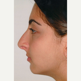 17 or under year old woman treated with Rhinoplasty before 3406276