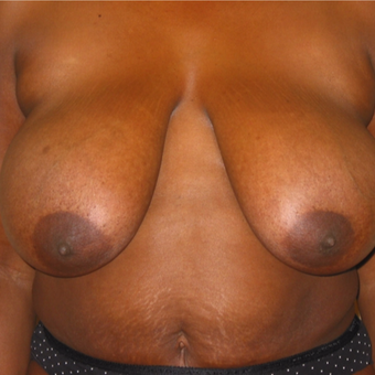 Breast Reduction on 40 year old Mommy Makeover Patient before 3092808