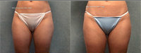 SmartLipo before 99282