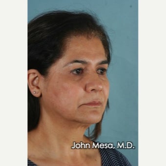 Facelift under pure Local Anesthesia before 1681636
