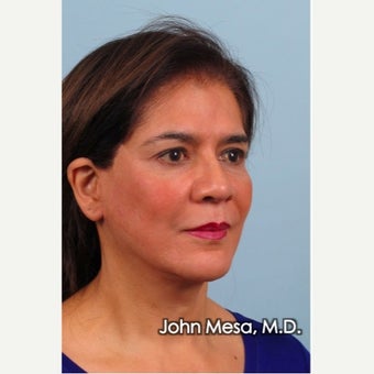 Facelift under pure Local Anesthesia after 1681636