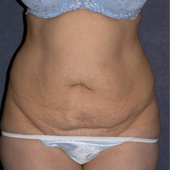 45-54 year old woman treated with Tummy Tuck before 3453620