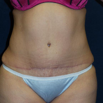 45-54 year old woman treated with Tummy Tuck after 3453620