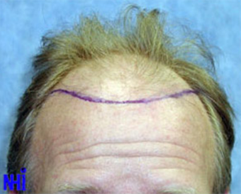 FUE Follicular Unit Transplant before 1970431
