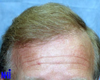 FUE Follicular Unit Transplant after 1970431