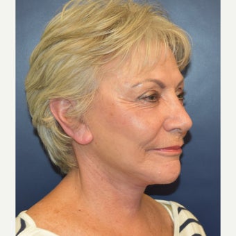 65-74 year old woman treated with Mini Lift after 2667035