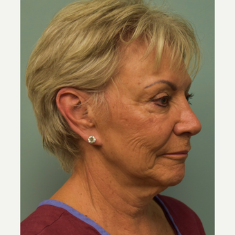 65-74 year old woman treated with Mini Lift before 2667035