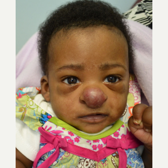 17 or under year old woman treated with Rhinoplasty before 3188569
