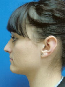 Otoplasty Ear Surgery - Female 818044