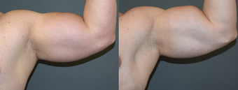 25-34 year old man treated with Vaser Liposuction before 4599323