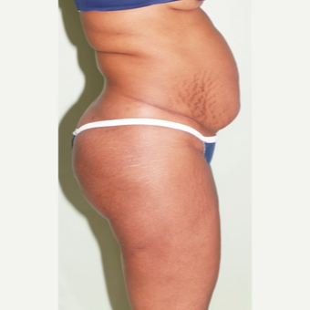 45-54 year old man treated with Tummy Tuck before 2977742