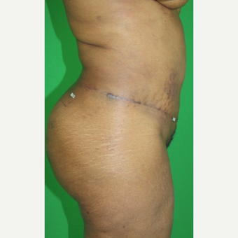 45-54 year old man treated with Tummy Tuck after 2977742