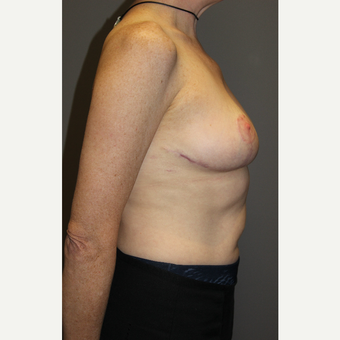 45-54 year old woman treated with Breast Lift after 3129311