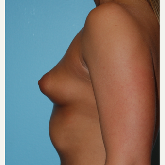20 year old woman, A to full C cup, 325 cc saline MPP implants filled to 350 cc before 3776053