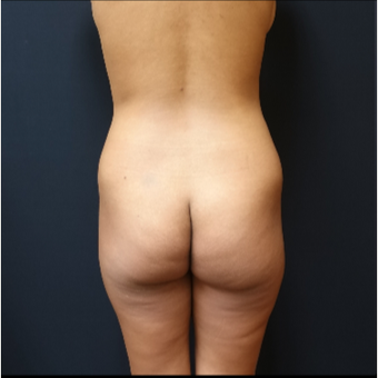 25-34 year old woman treated with Butt Augmentation before 3731669