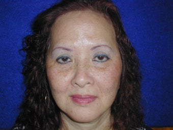 Browlift after 652572
