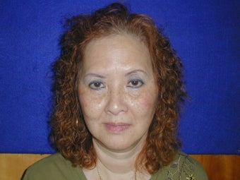 Browlift before 652572