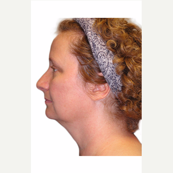 45-54 year old woman treated with Neck Lift before 3409114