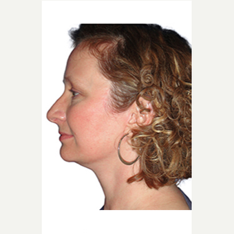 45-54 year old woman treated with Neck Lift after 3409114