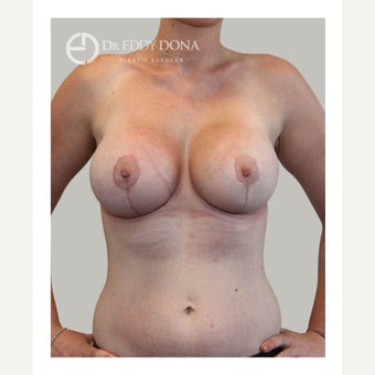 18-24 year old woman treated with Breast Lift with Implants after 1617945