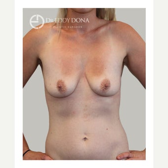 18-24 year old woman treated with Breast Lift with Implants before 1617945