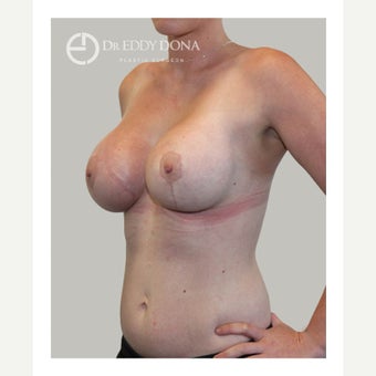 18-24 year old woman treated with Breast Lift with Implants 1617945