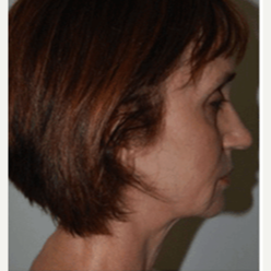 45-54 year old woman treated with Facelift before 3500732