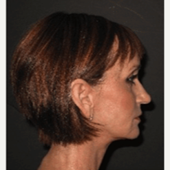 45-54 year old woman treated with Facelift after 3500732