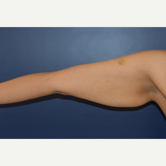 35-44 year old woman treated with Arm Lift before 3408497