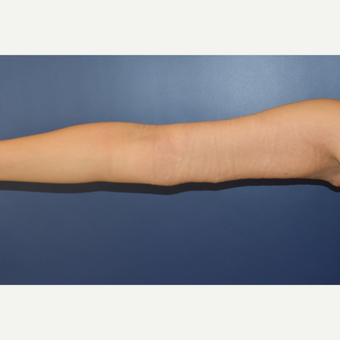 35-44 year old woman treated with Arm Lift after 3408497