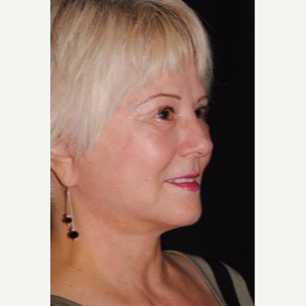 55-64 year old woman treated with Facelift after 3481215