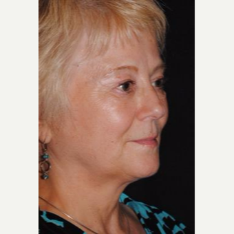 55-64 year old woman treated with Facelift before 3481215