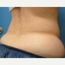 57 year old woman treated with CoolSculpting before 1944813