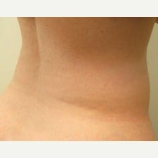 57 year old woman treated with CoolSculpting after 1944813