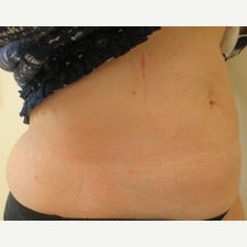 57 year old woman treated with CoolSculpting 1944813