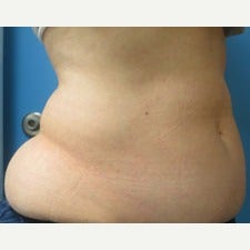 57 year old woman treated with CoolSculpting 1944813