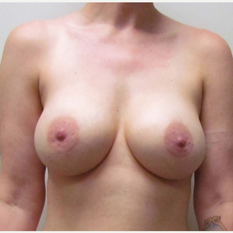Breast Implant Replacement for this 38 Year Old Woman before 3791580