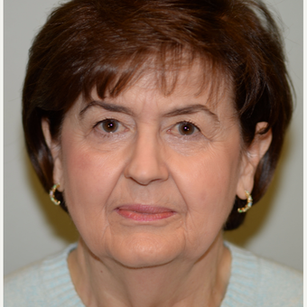 68 year old woman treated with Face and Neck Lift before 3241120