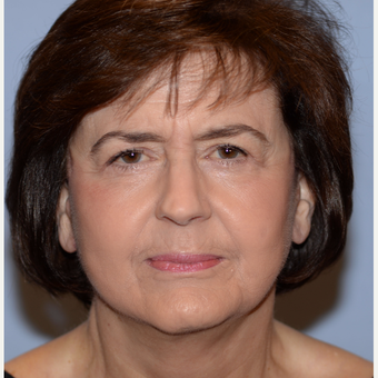 68 year old woman treated with Face and Neck Lift after 3241120