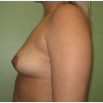 25-34 year old woman treated with Breast Implants before 3423929