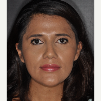 25-34 year old woman treated with Rhinoplasty 10 days post-op after 3452292