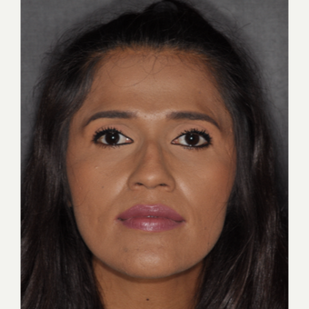 25-34 year old woman treated with Rhinoplasty 10 days post-op before 3452292