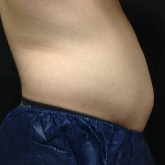 35-44 year old man treated with CoolSculpting after 3140236