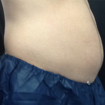35-44 year old man treated with CoolSculpting before 3140236